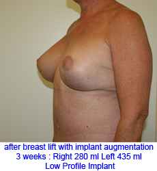 plastic-surgery-breast-lift-augmentation